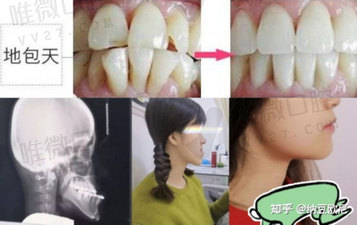 牙周治疗痛苦吗（治疗牙周炎难受吗）(图1)